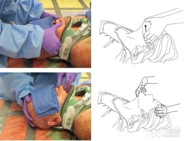 托举下颌法与按额抬颌法