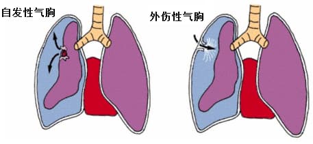 气胸的机制
