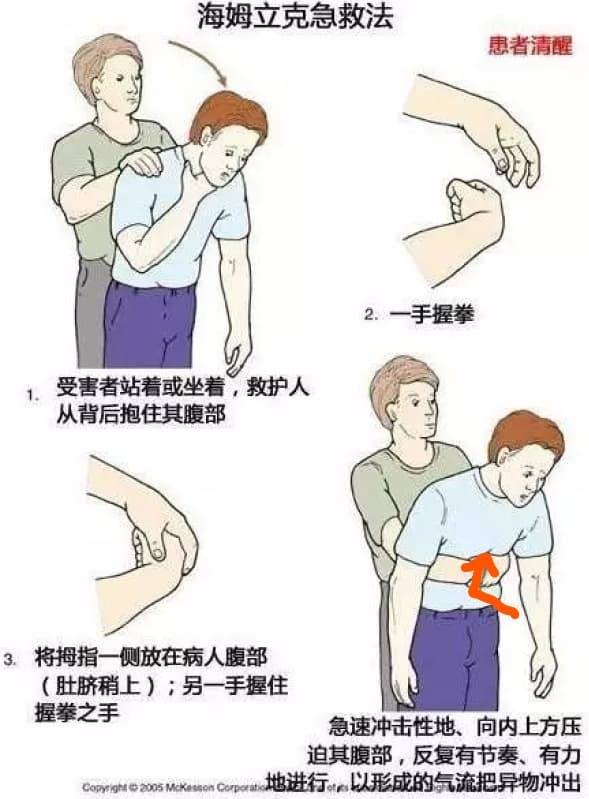 成人海姆立克图