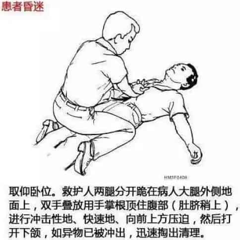 昏迷海姆立克图