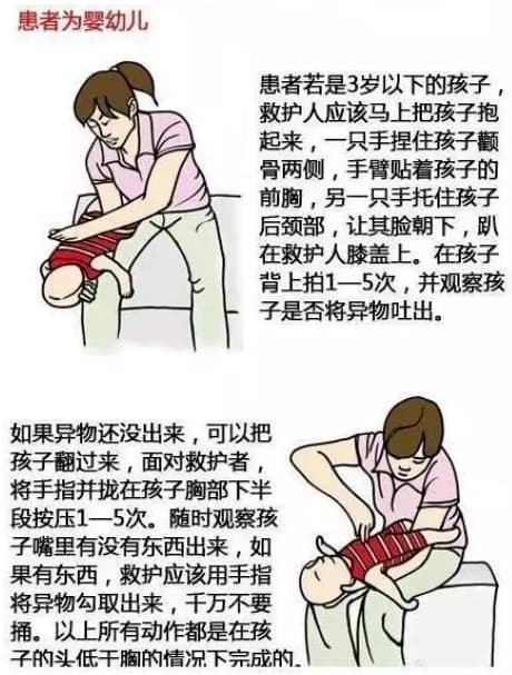 婴儿海姆立克图